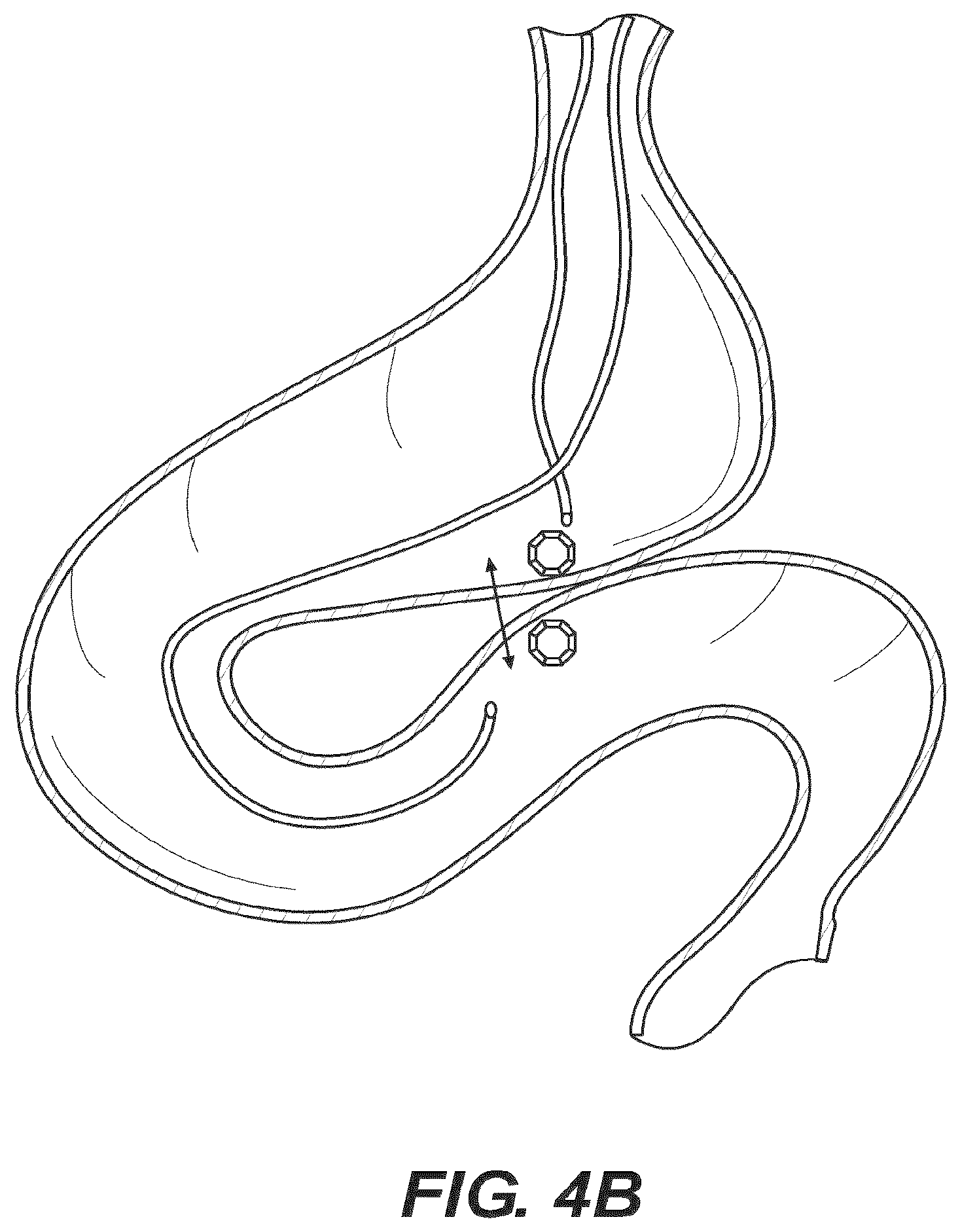 Patent US12616477 Figure 5 – Pressure profile magnetic compression anastomosis devices