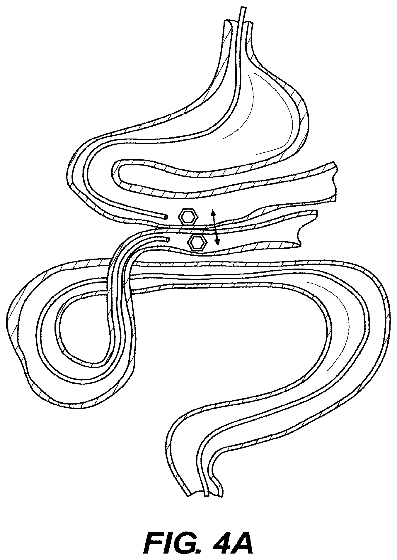 Patent US12616478 Figure 4 – Magnetic compression anastomosis devices with multipiece internal vertebrae support structures