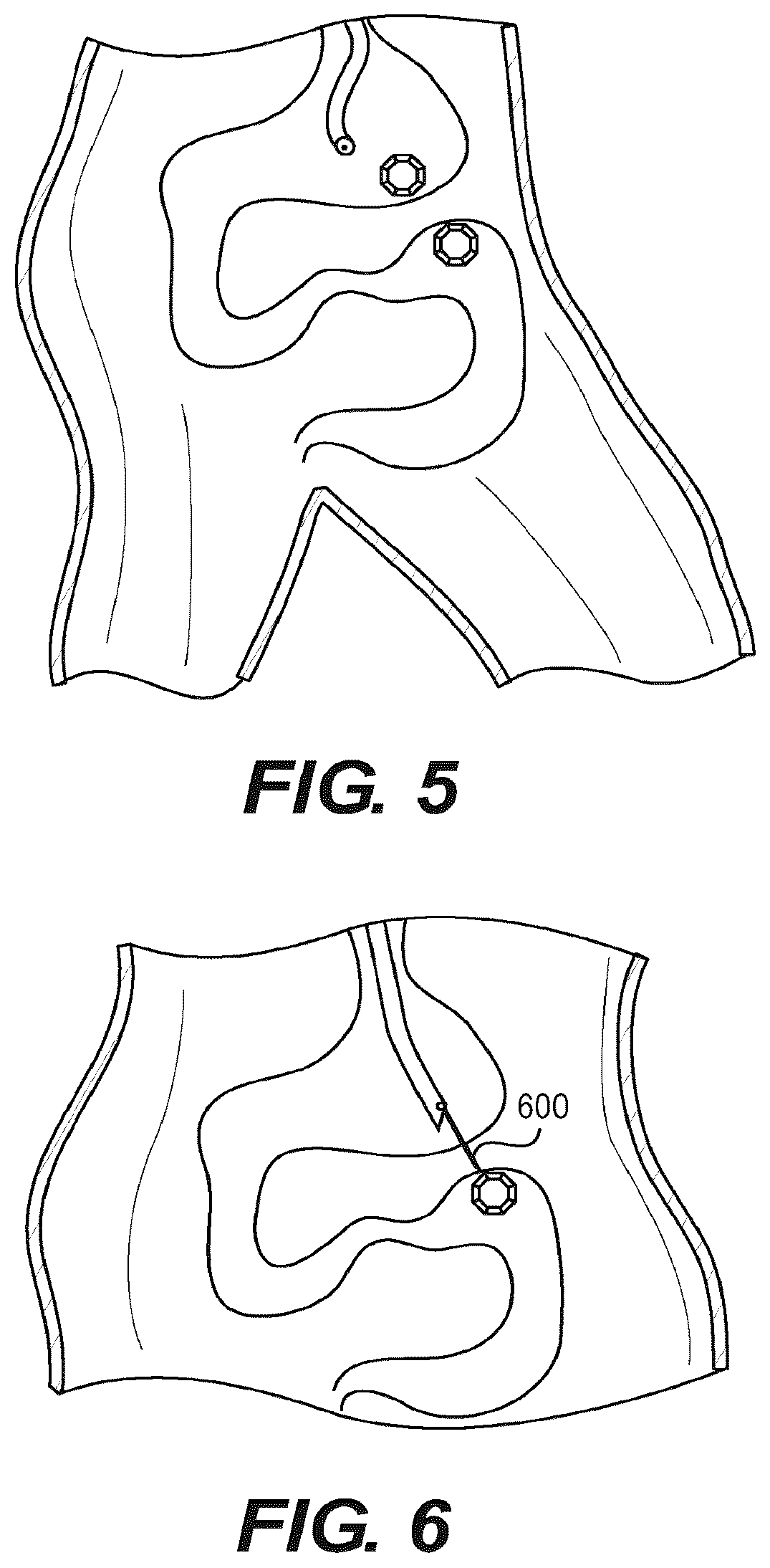 Patent US12616478 Figure 6 – Magnetic compression anastomosis devices with multipiece internal vertebrae support structures