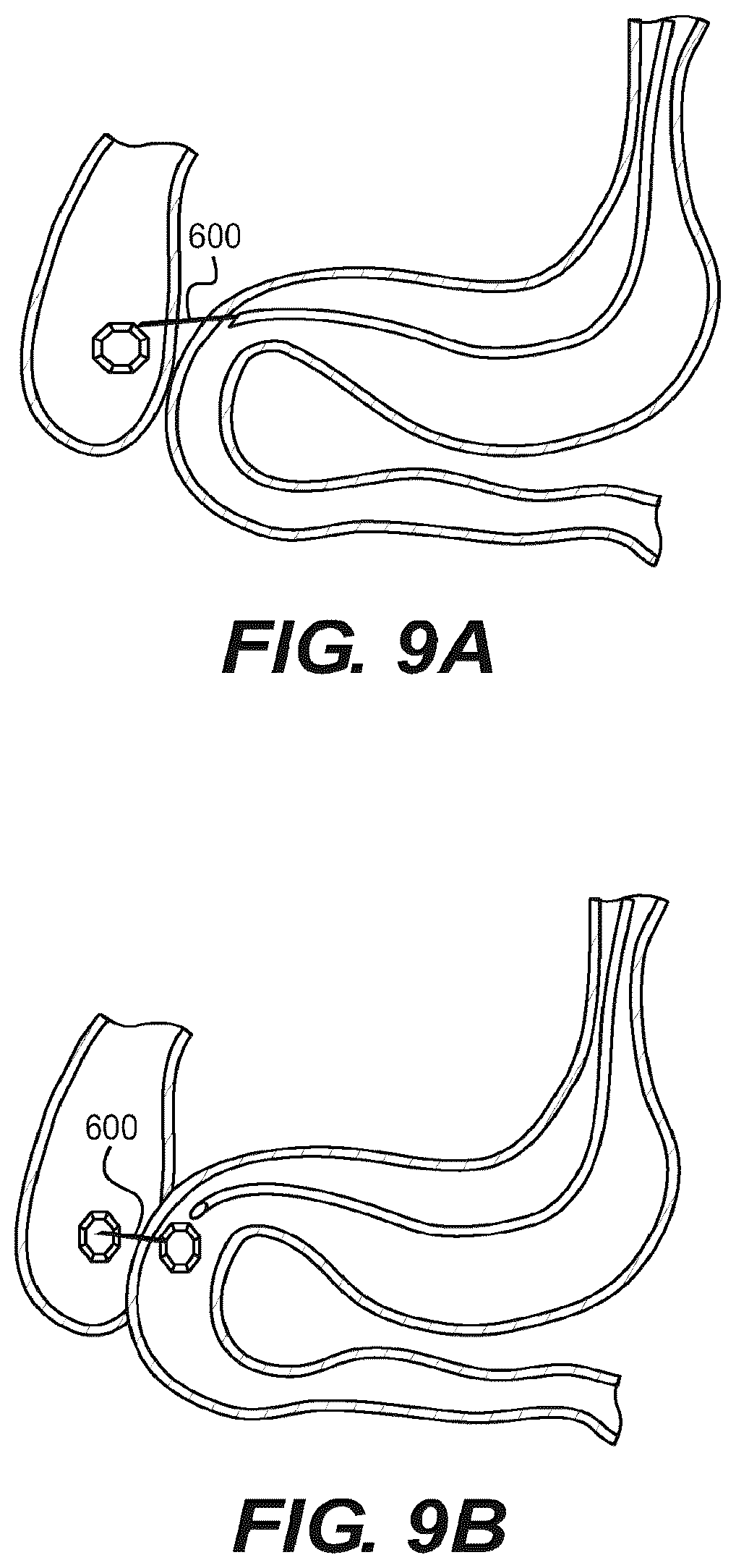 Patent US12616478 Figure 8 – Magnetic compression anastomosis devices with multipiece internal vertebrae support structures