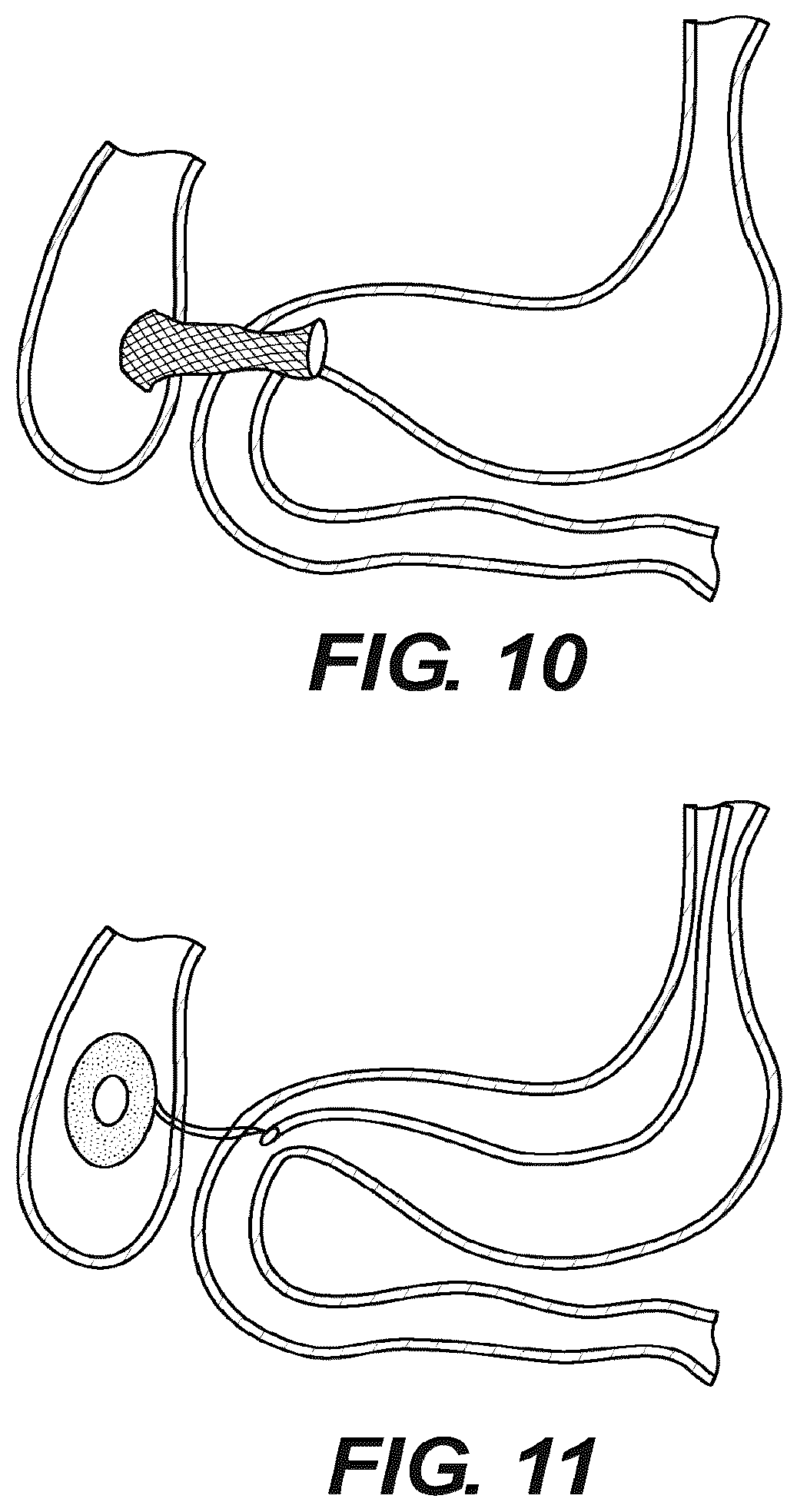 Patent US12616478 Figure 9 – Magnetic compression anastomosis devices with multipiece internal vertebrae support structures