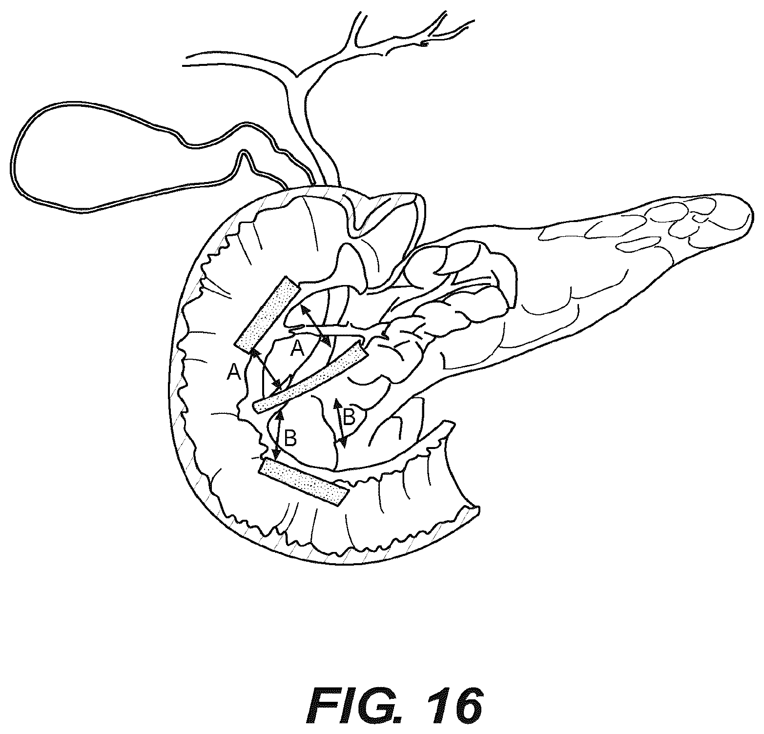 Patent US12616478 Figure 12 – Magnetic compression anastomosis devices with multipiece internal vertebrae support structures