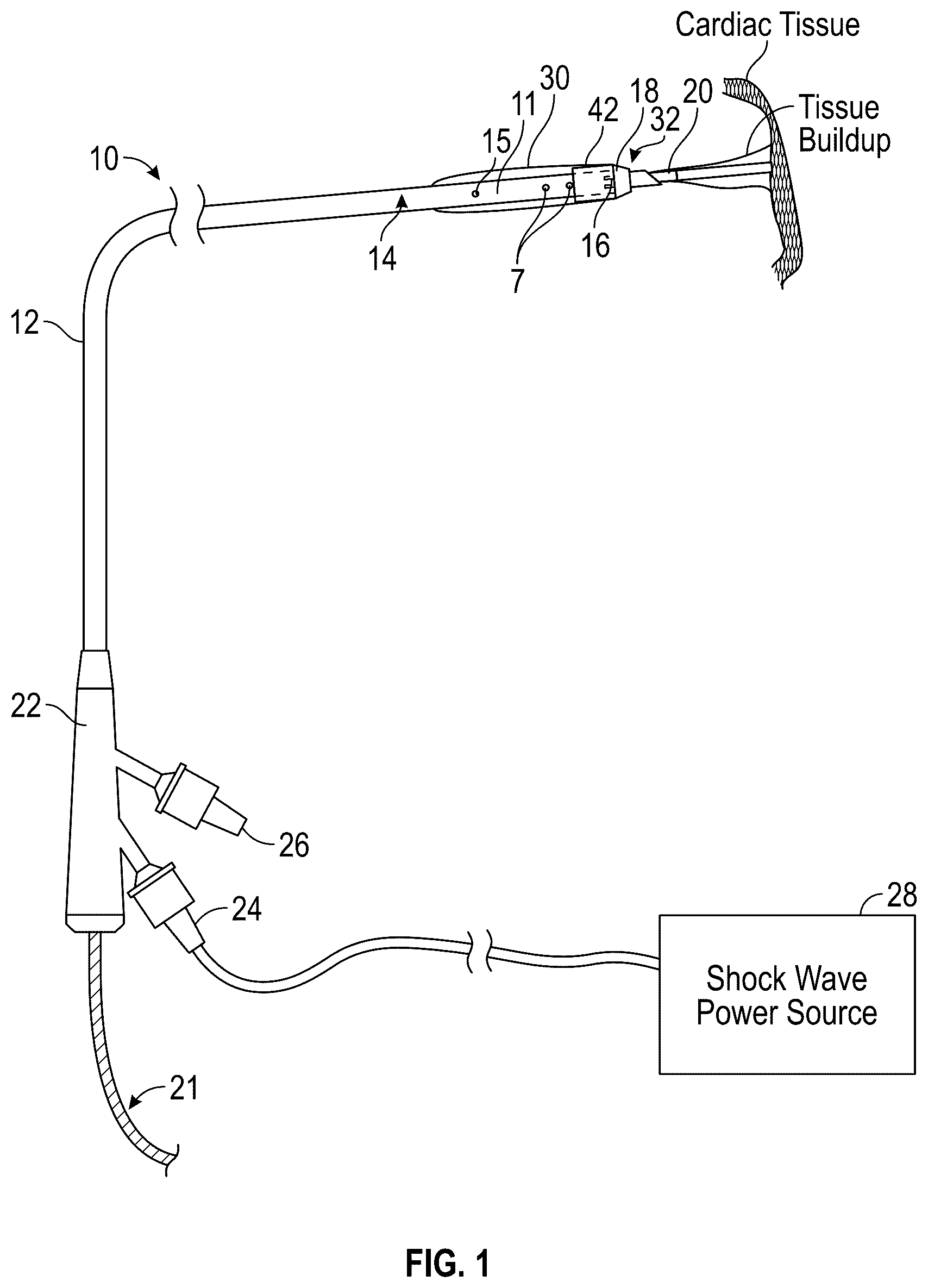 Patent US12616490 Figure 1 – Systems, devices, and methods for treatment of target material in a body lumen with shock waves
