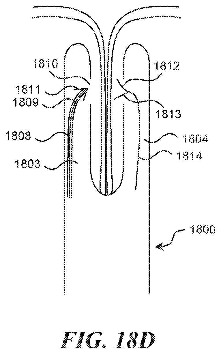Patent US12616499 Figure 18 – Systems and methods for endoluminal valve creation