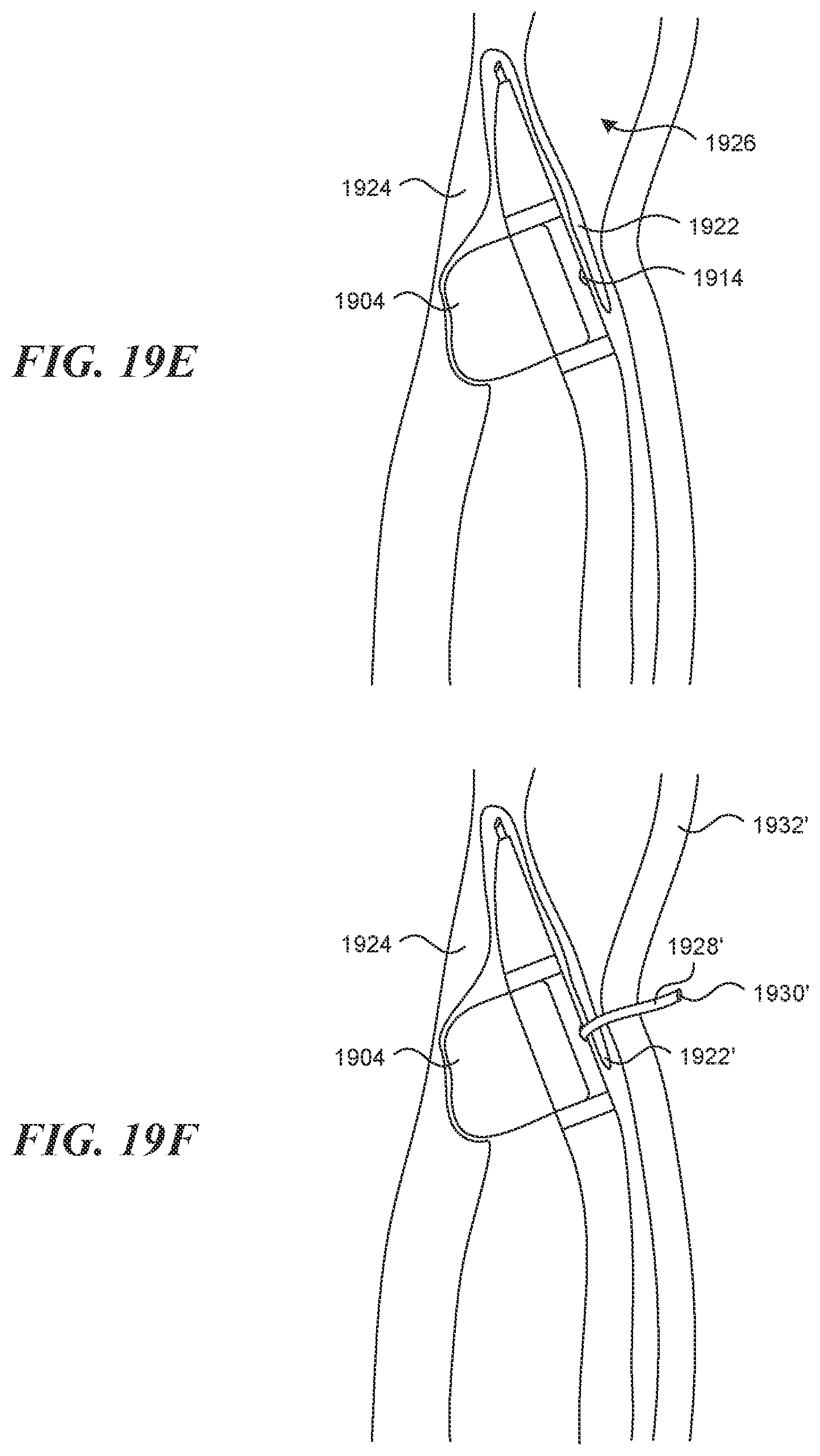 Patent US12616499 Figure 20 – Systems and methods for endoluminal valve creation