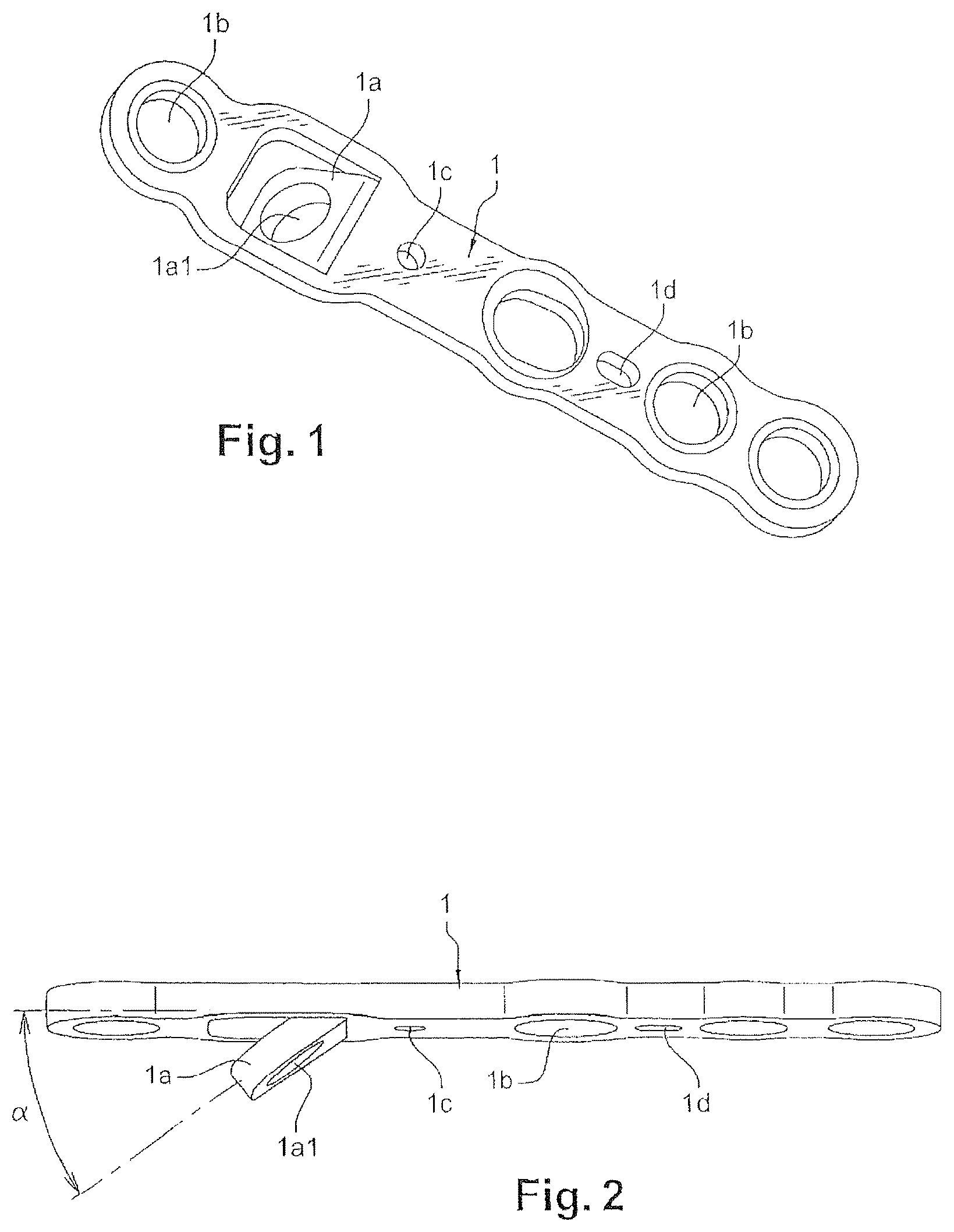 Patent US12616507 Figure 1 – Orthopedic implant in the form of a plate to be fixed between two bone parts