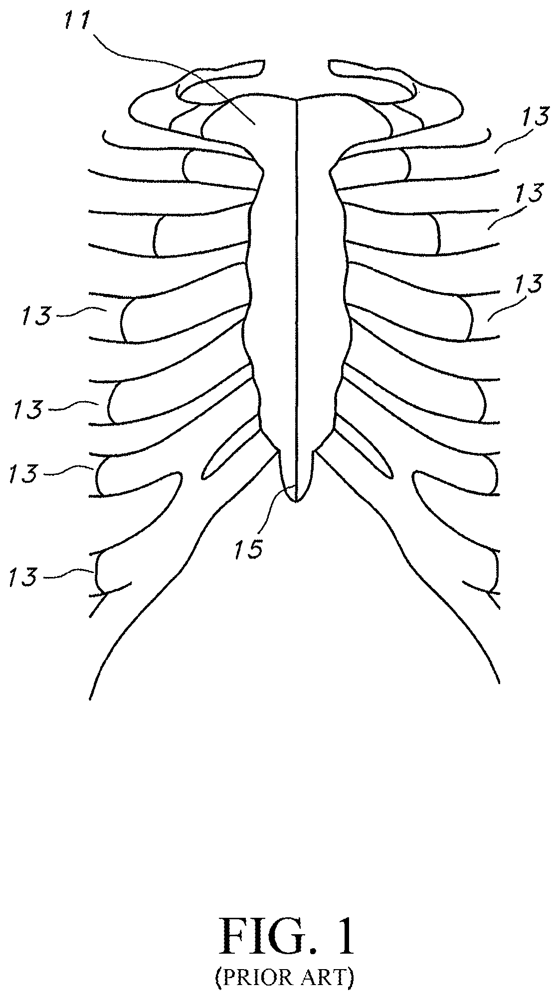 Patent US12616509 — Sternum fixation device and method — Figure 1
