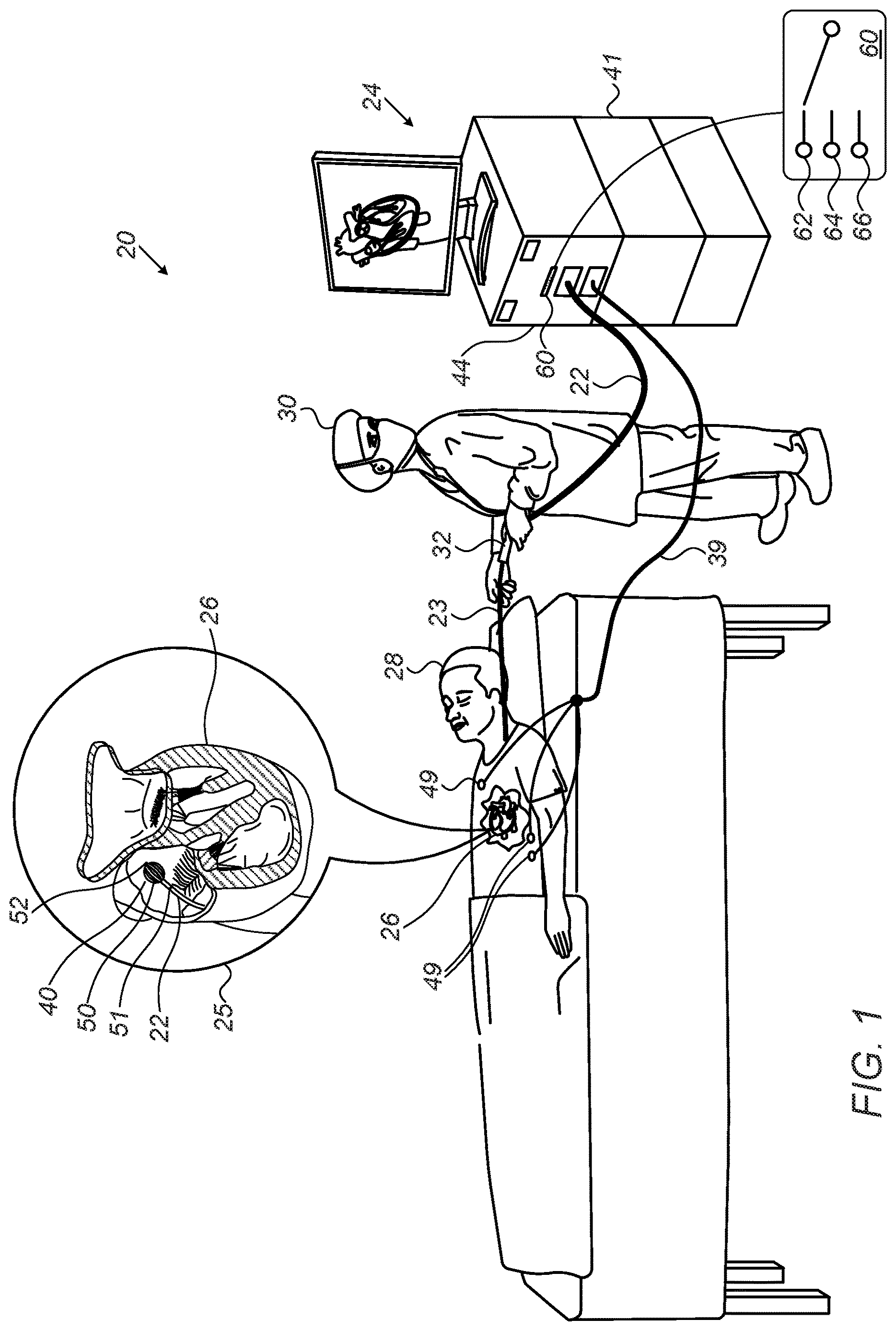 Patent US12616515 — Estimation of electrode-tissue contact using stem and edge electrodes — Figure 1