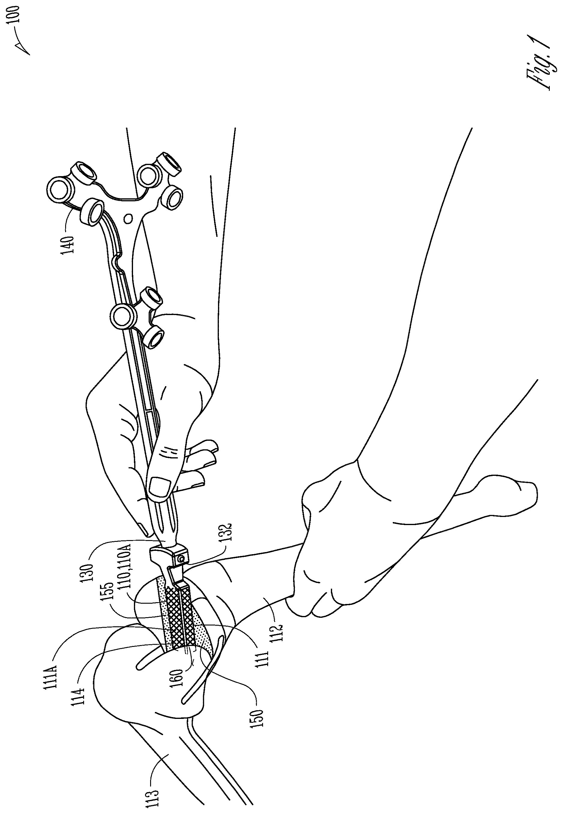 Patent US12616530 — Knee arthroplasty combination validation instrument and bone removal tool — Figure 1
