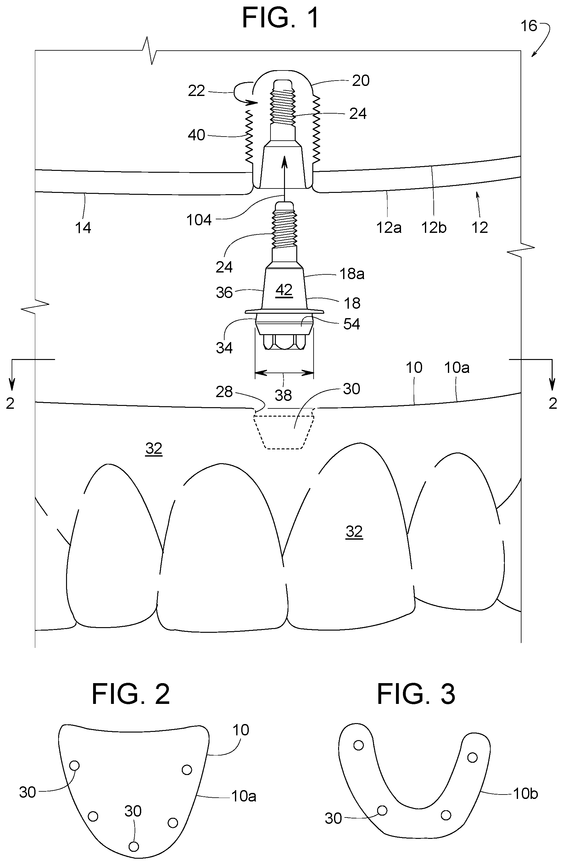 Patent US12616558 — Direct-snap dental abutment systems — Figure 1
