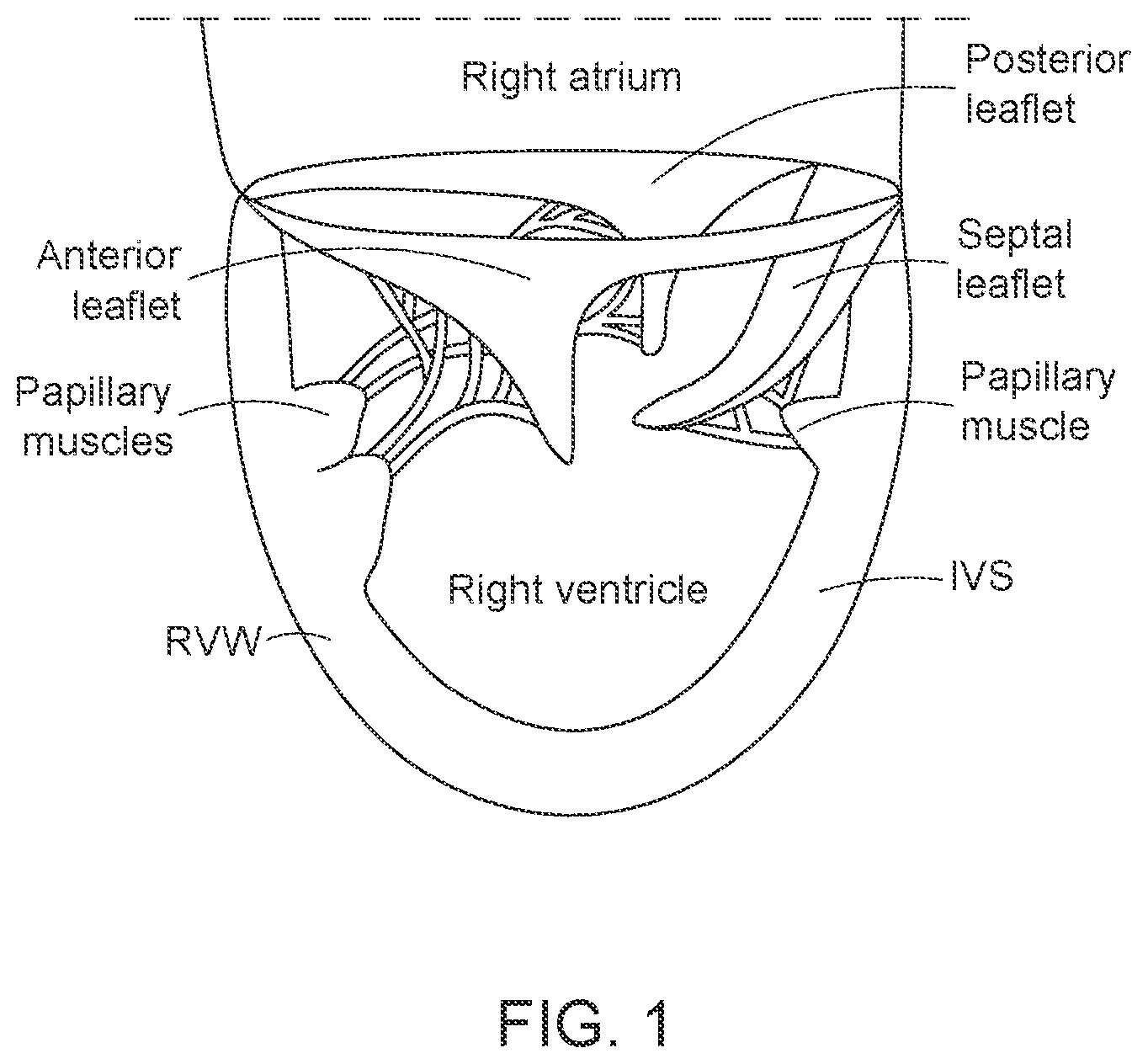 Patent US12616568 — Two stage tricuspid valve implant — Figure 1