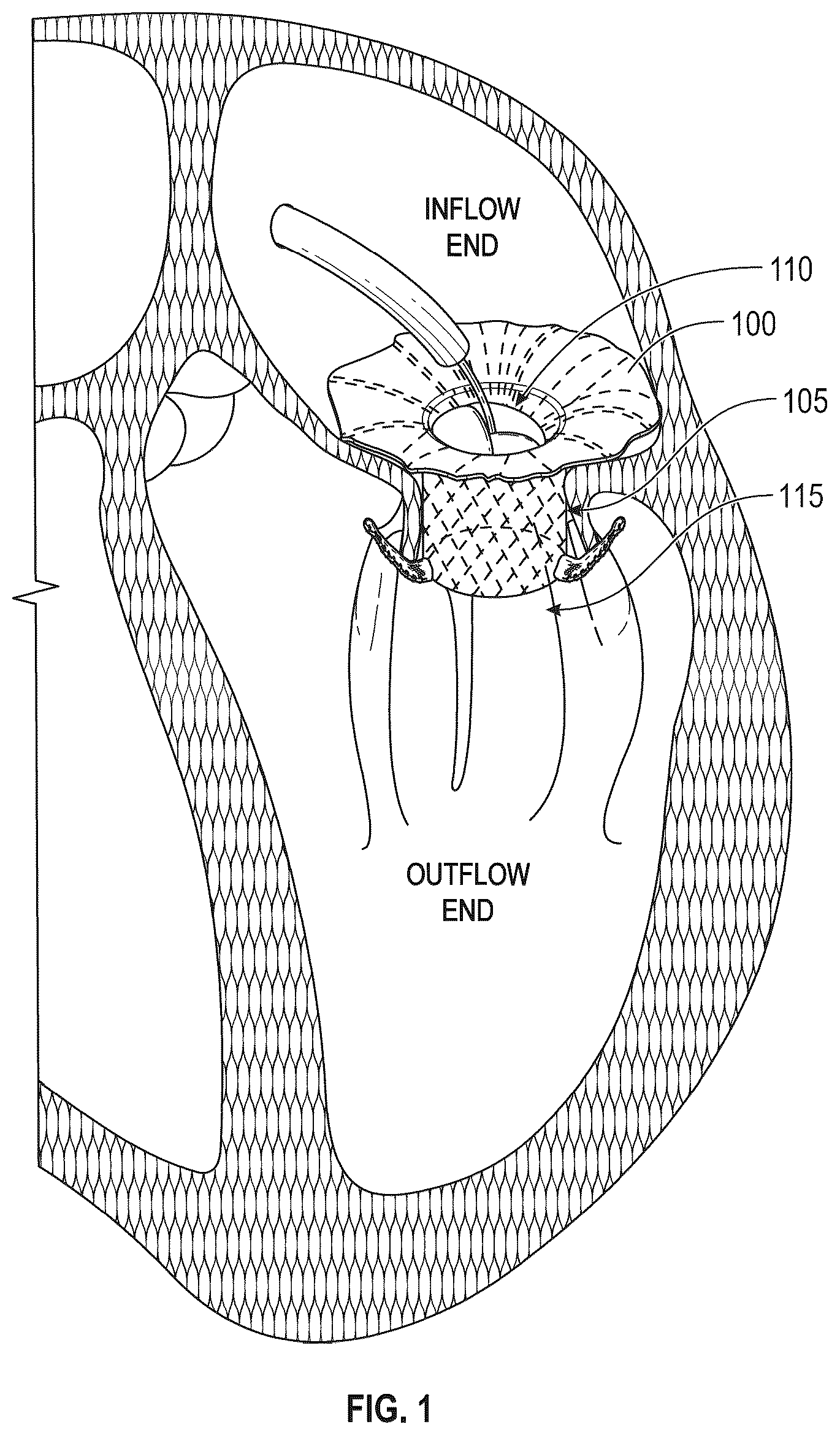 Patent US12616572 — Devices, systems, and methods for a valve replacement — Figure 1