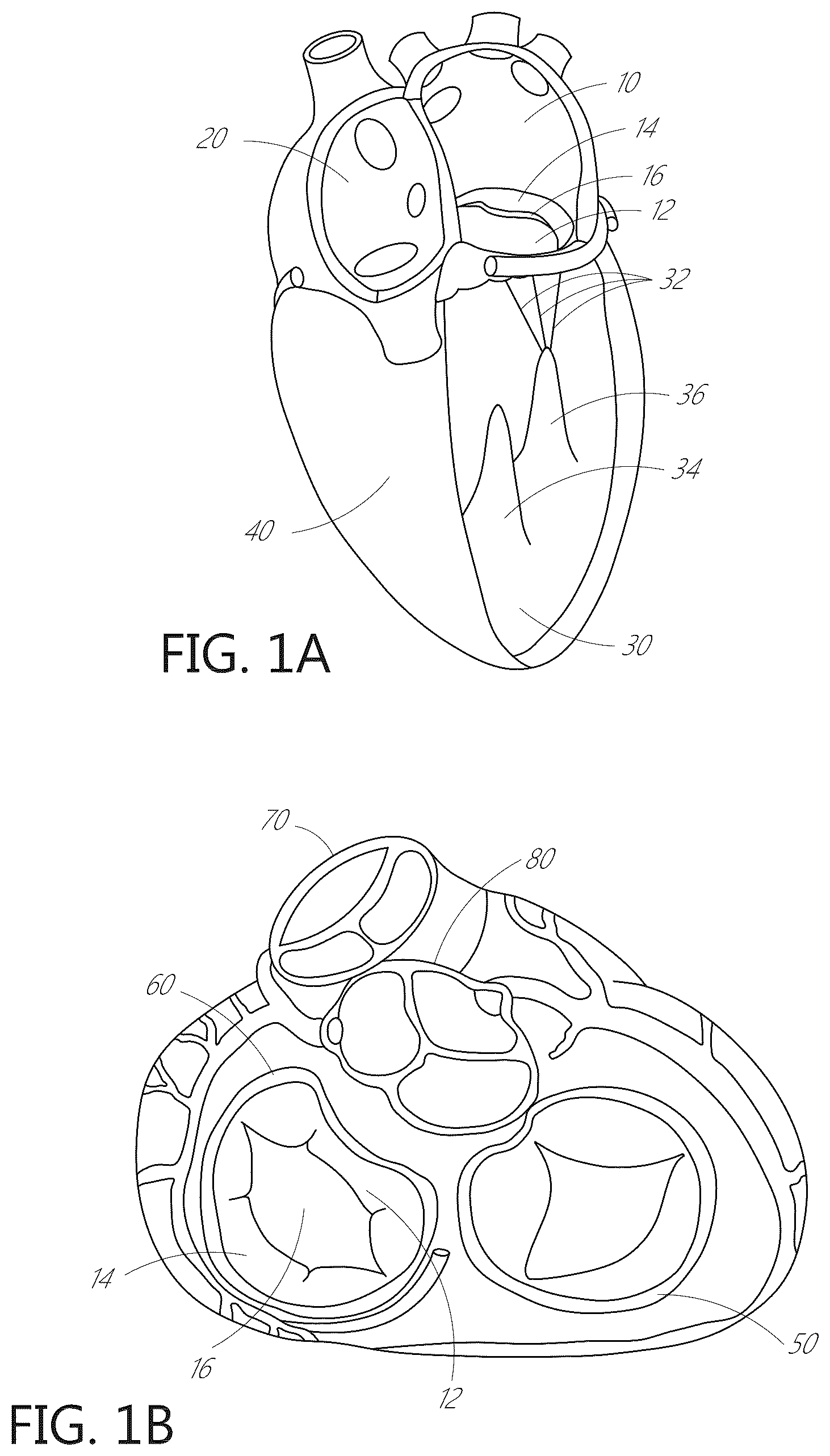 Patent US12616574 — Device, system, and method for transcatheter treatment of valvular regurgitation — Figure 1