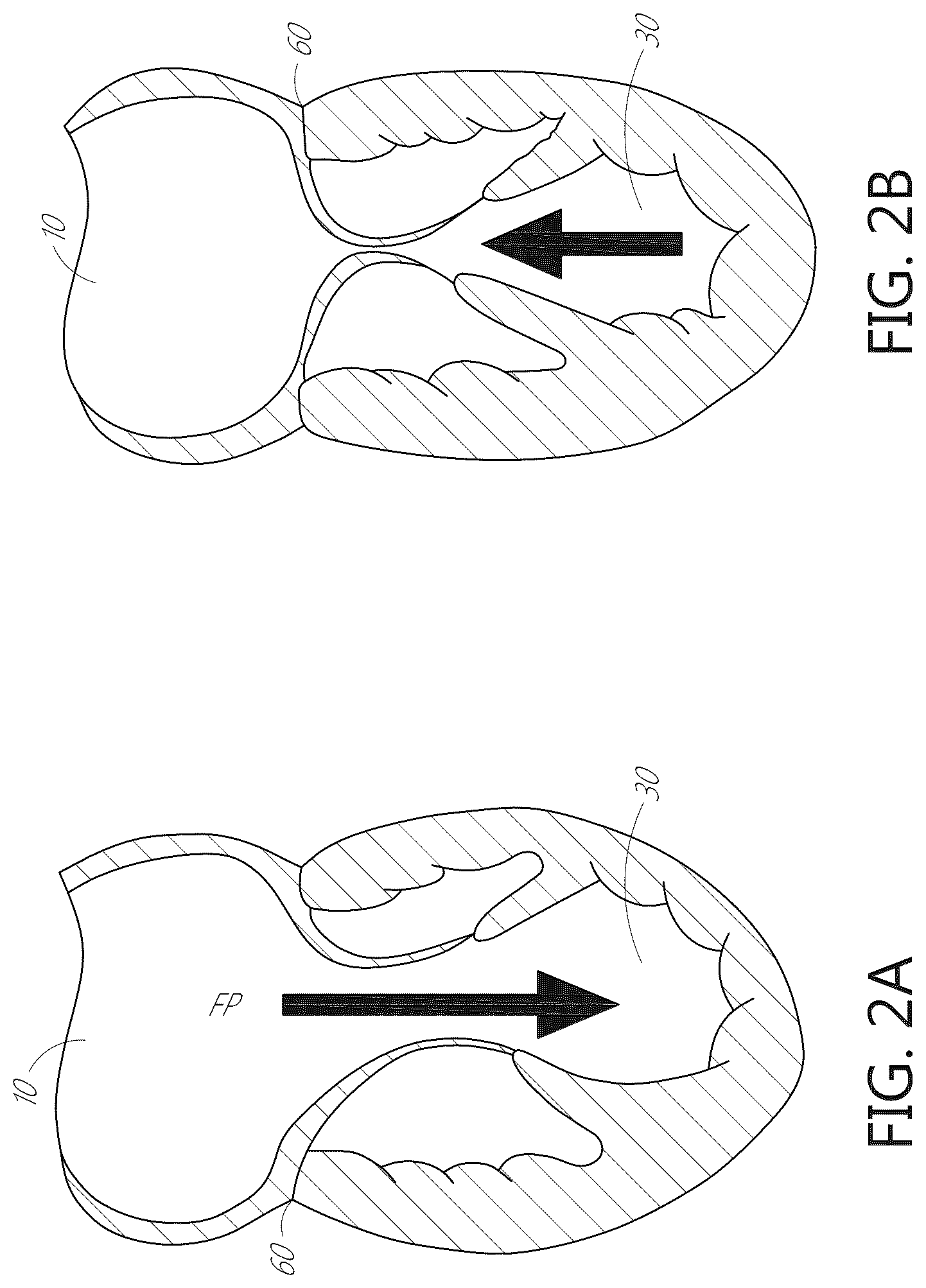 Patent US12616574 Figure 5 – Device, system, and method for transcatheter treatment of valvular regurgitation