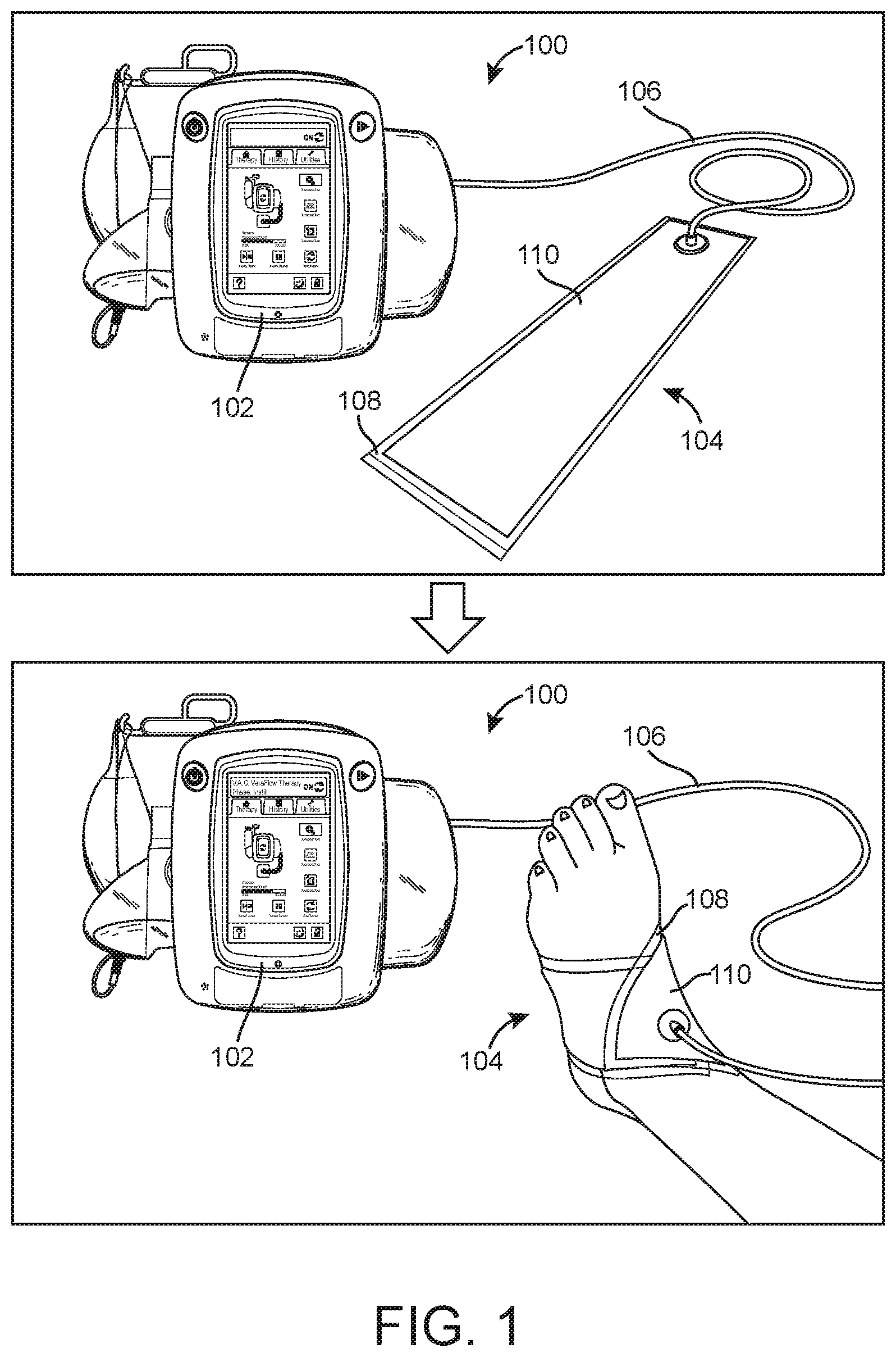 Patent US12616596 — Negative pressure therapy system with immobilizing locking sheets — Figure 1