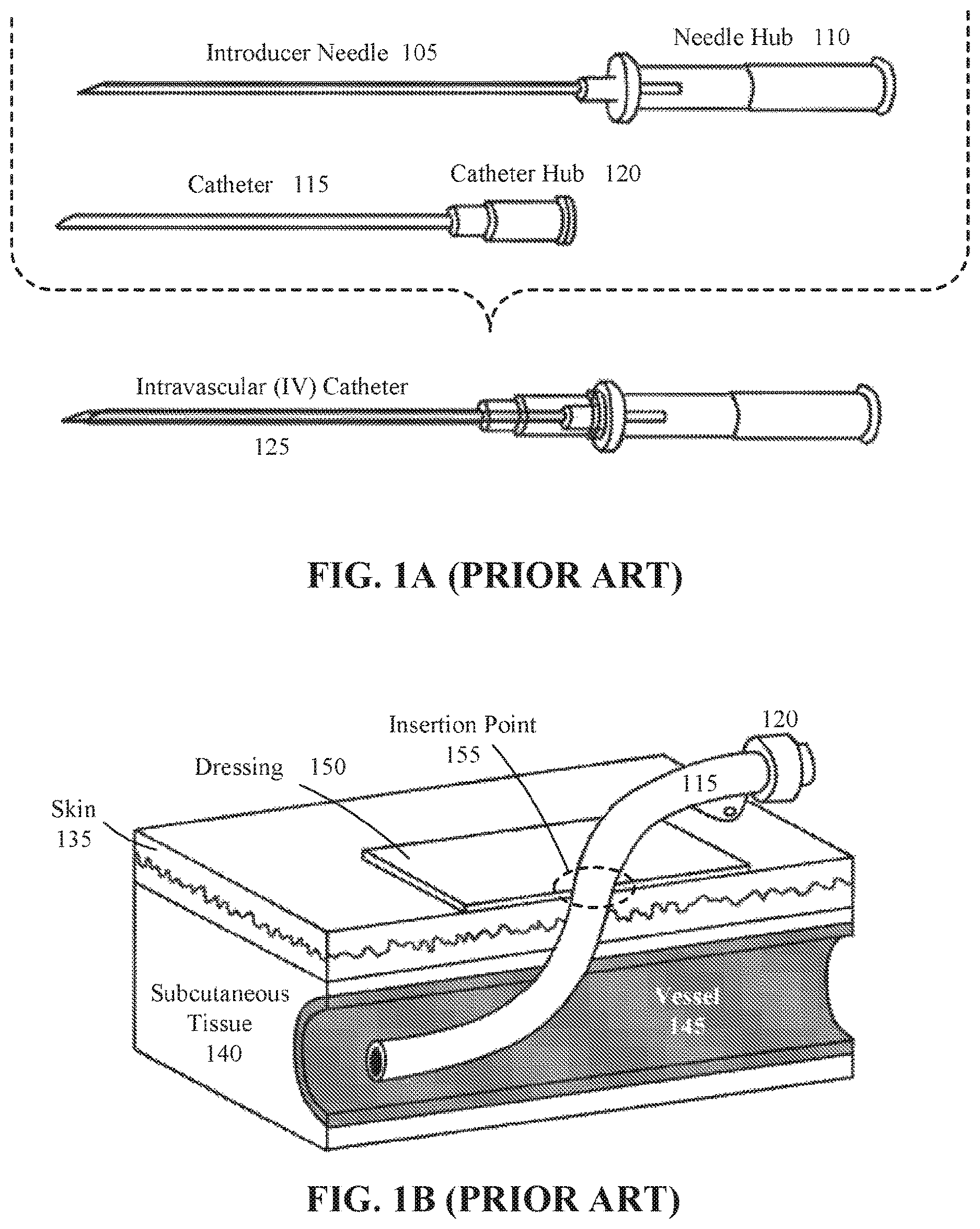 Patent US12616815 — Intravenous catheter reinforced to maintain volumetric integrity — Figure 1