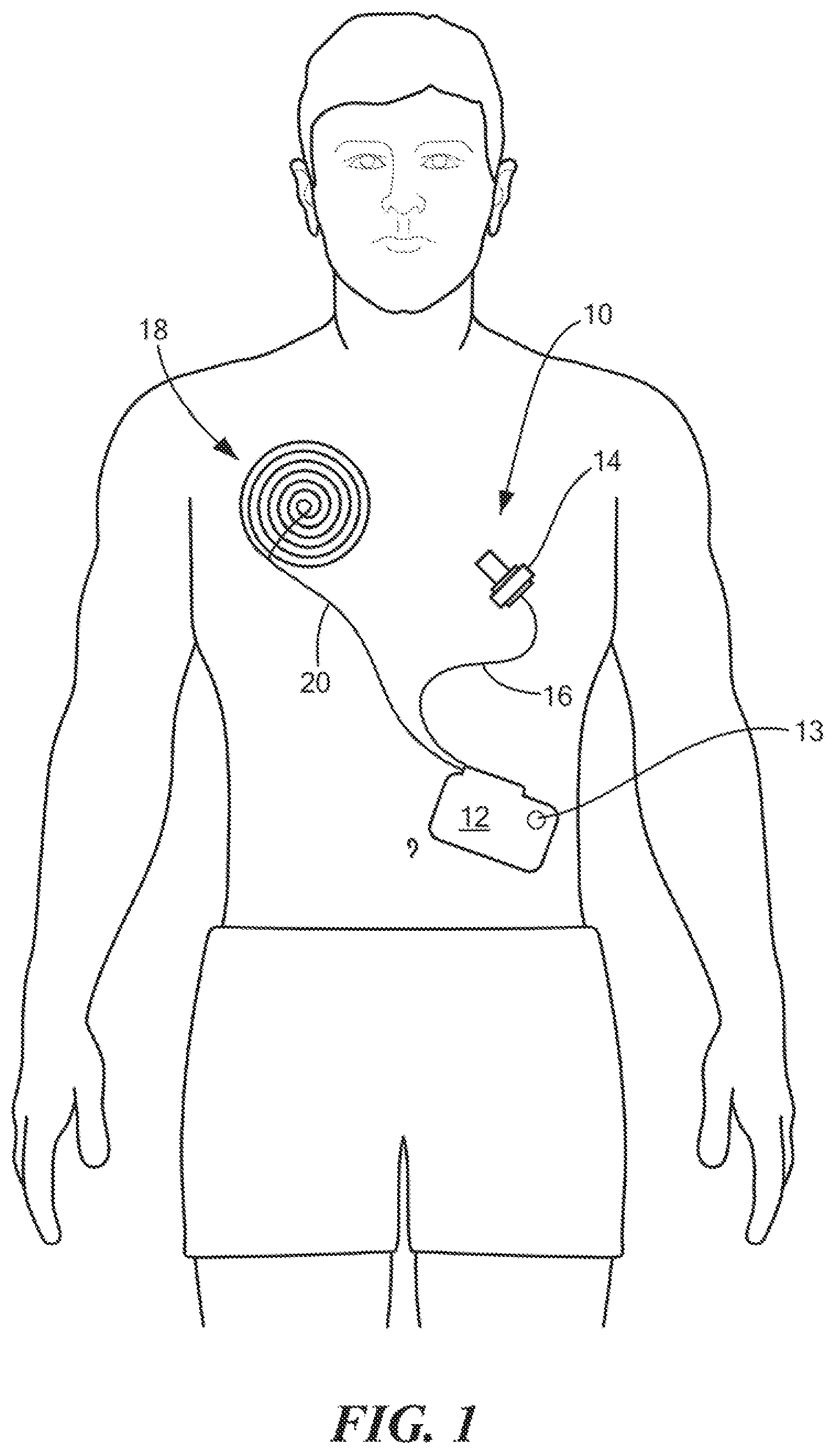 Patent US12616828 — Detecting heating of implanted coil hermetic package when misaligned — Figure 1