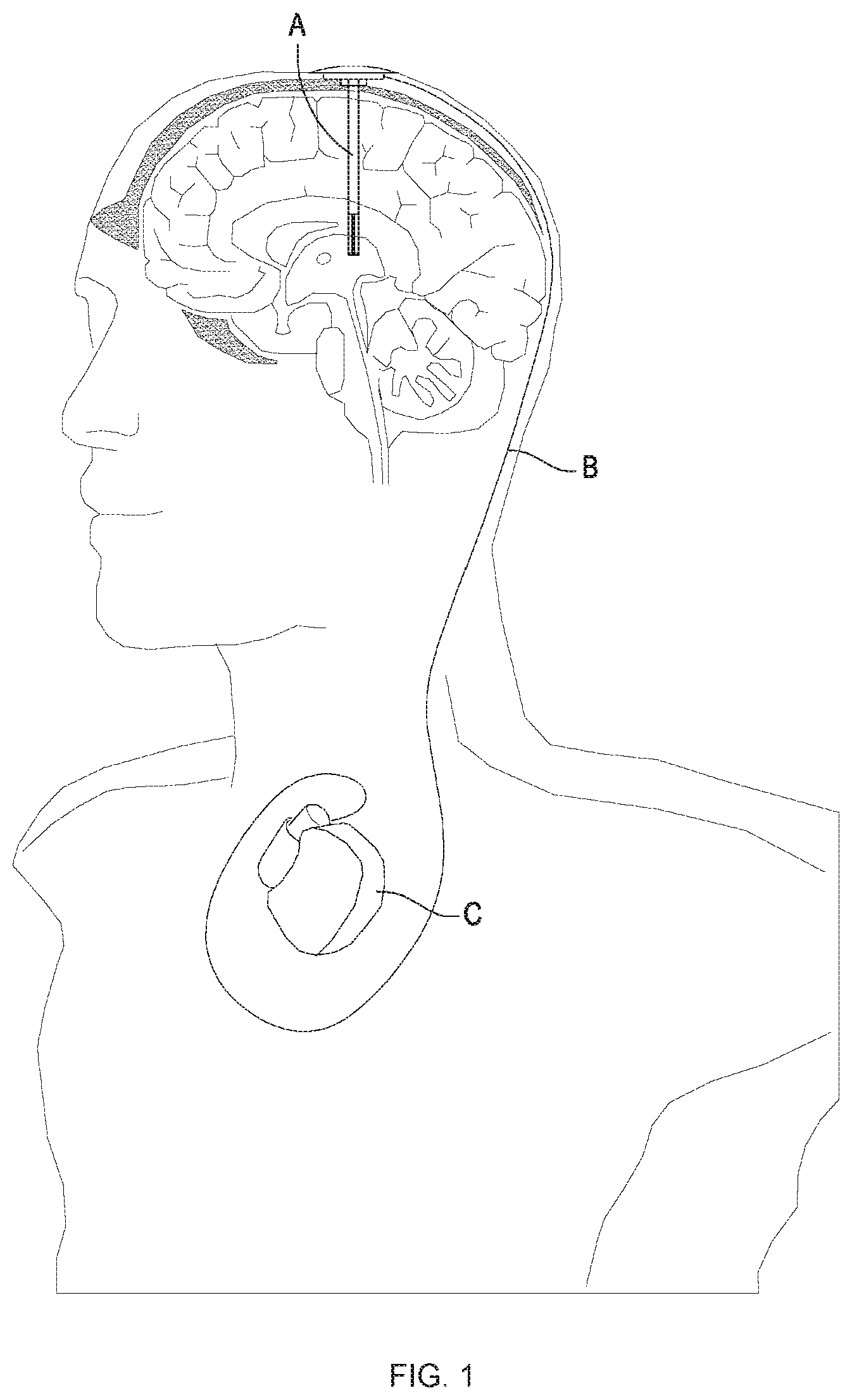 Patent US12616830 Figure 1 – Lead structure for applying electrical stimulation to body organ, and electrode system using same