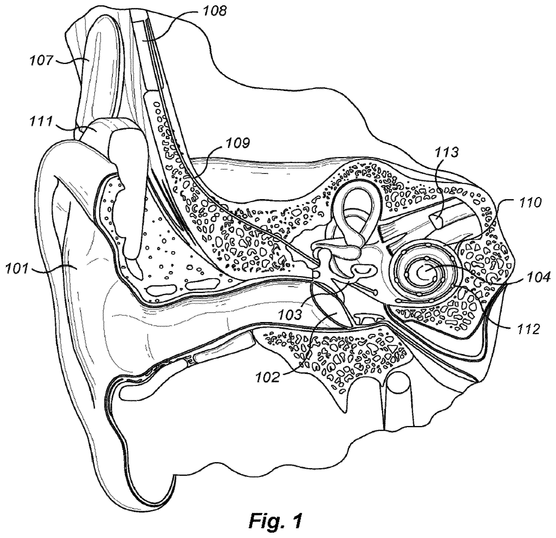 Patent US12616838 — Patient specific frequency mapping procedure for hearing implant electrode arrays — Figure 1