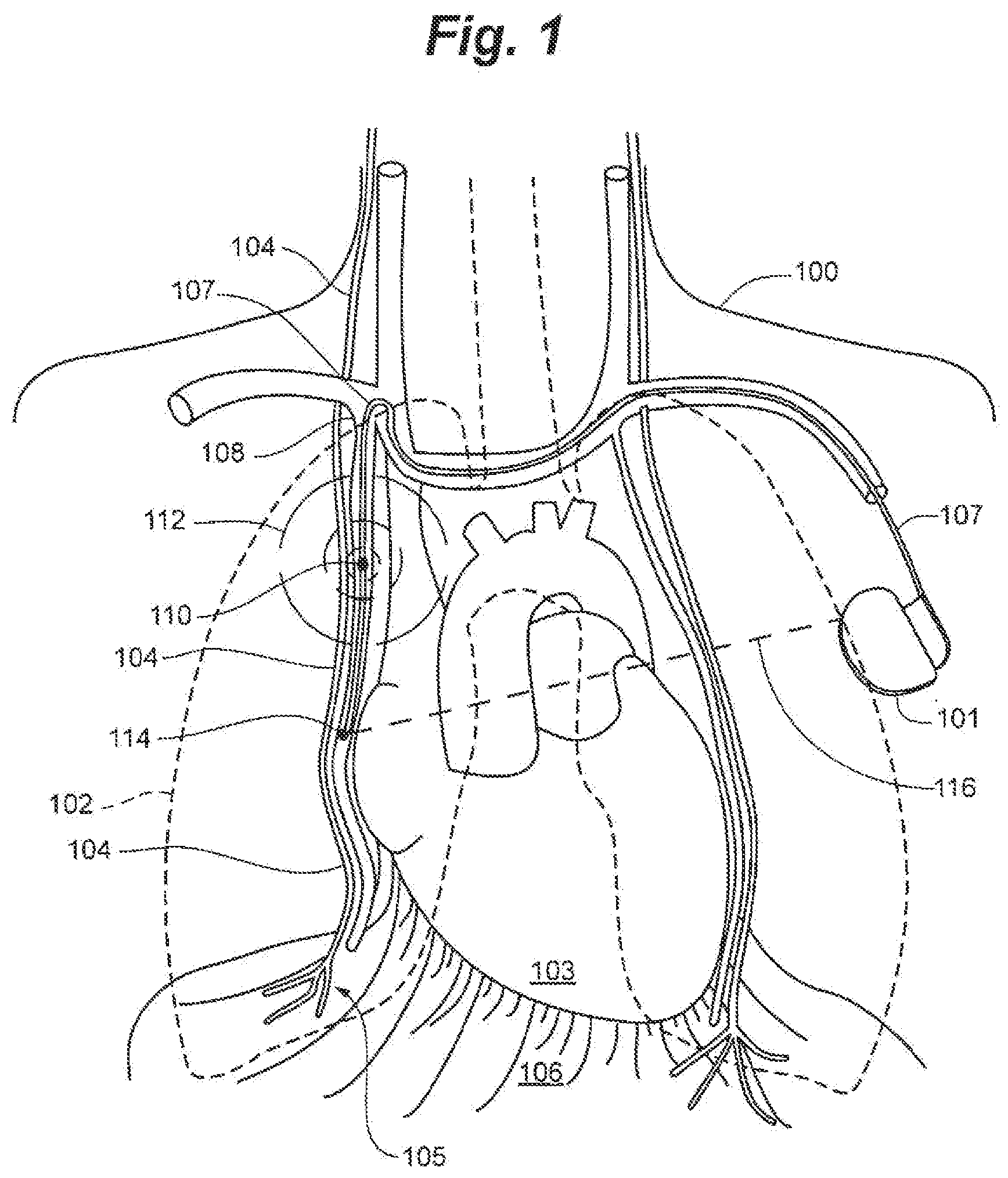 Patent US12616839 — System and method to modulate phrenic nerve to prevent sleep apnea — Figure 1