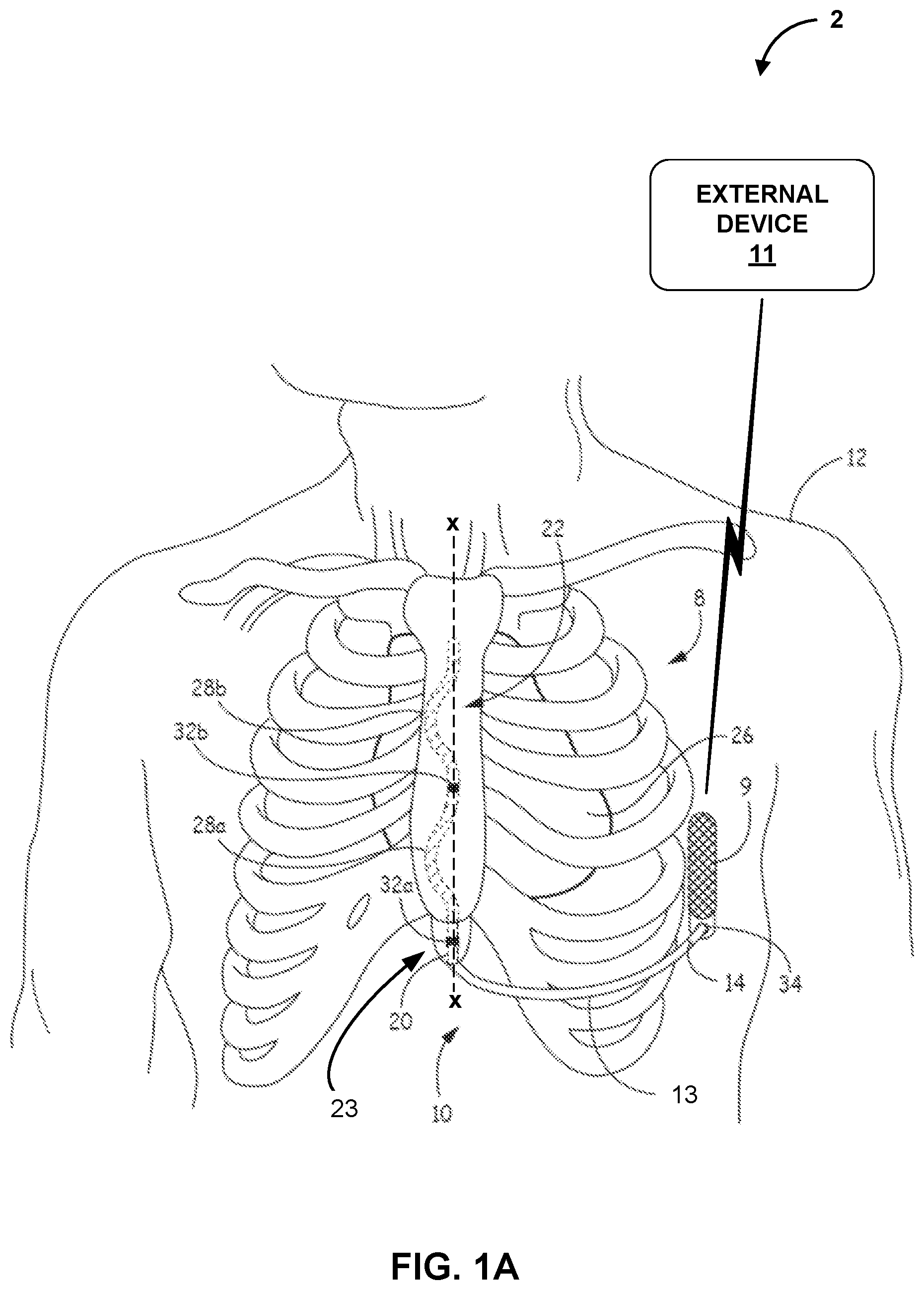 Patent US12616841 — Implantable medical device for detecting acoustic communication signals and acoustic biometric signals — Figure 1