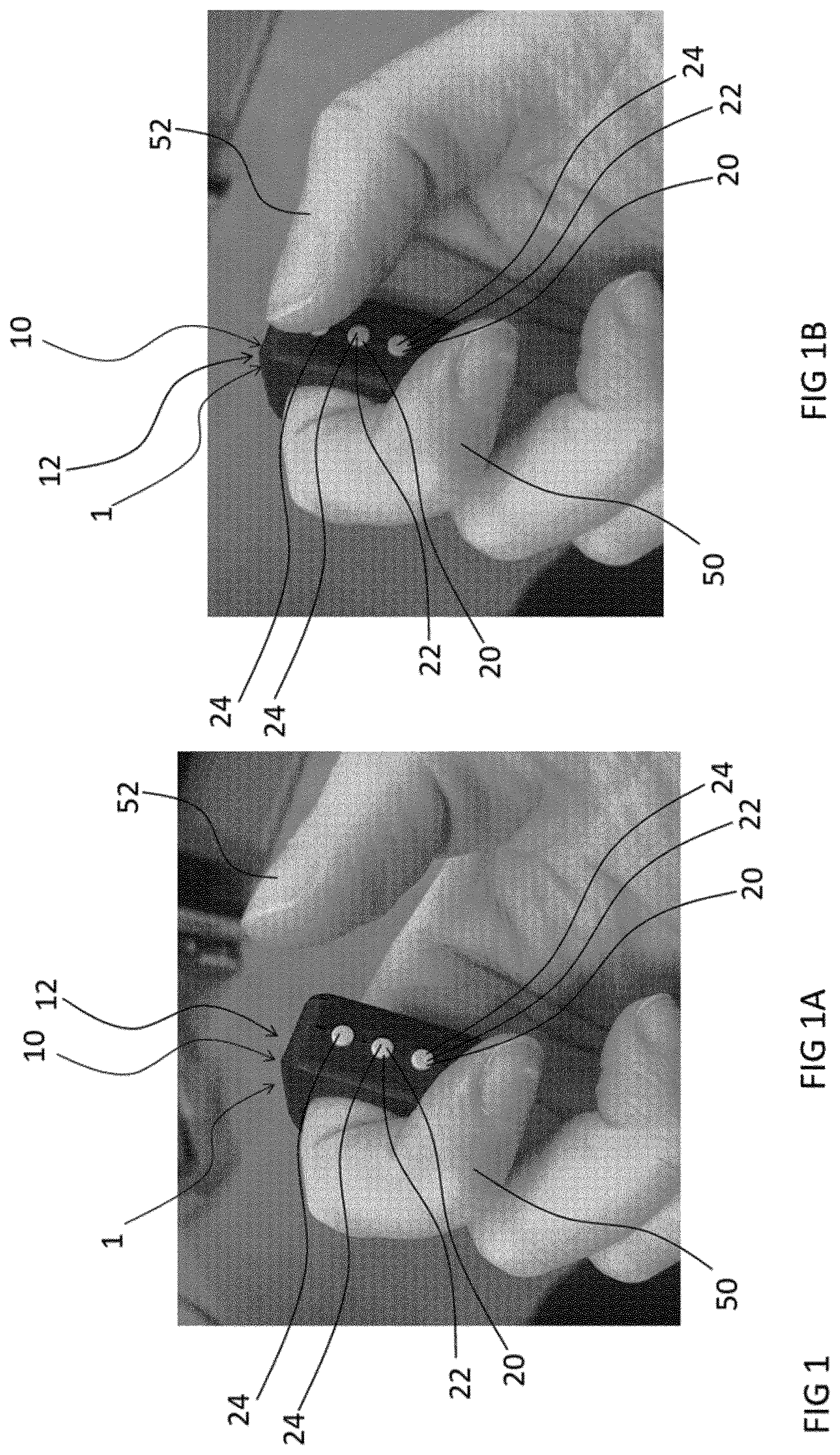 Patent US12619306 — Wearable control system and method to control an ear-worn device — Figure 1