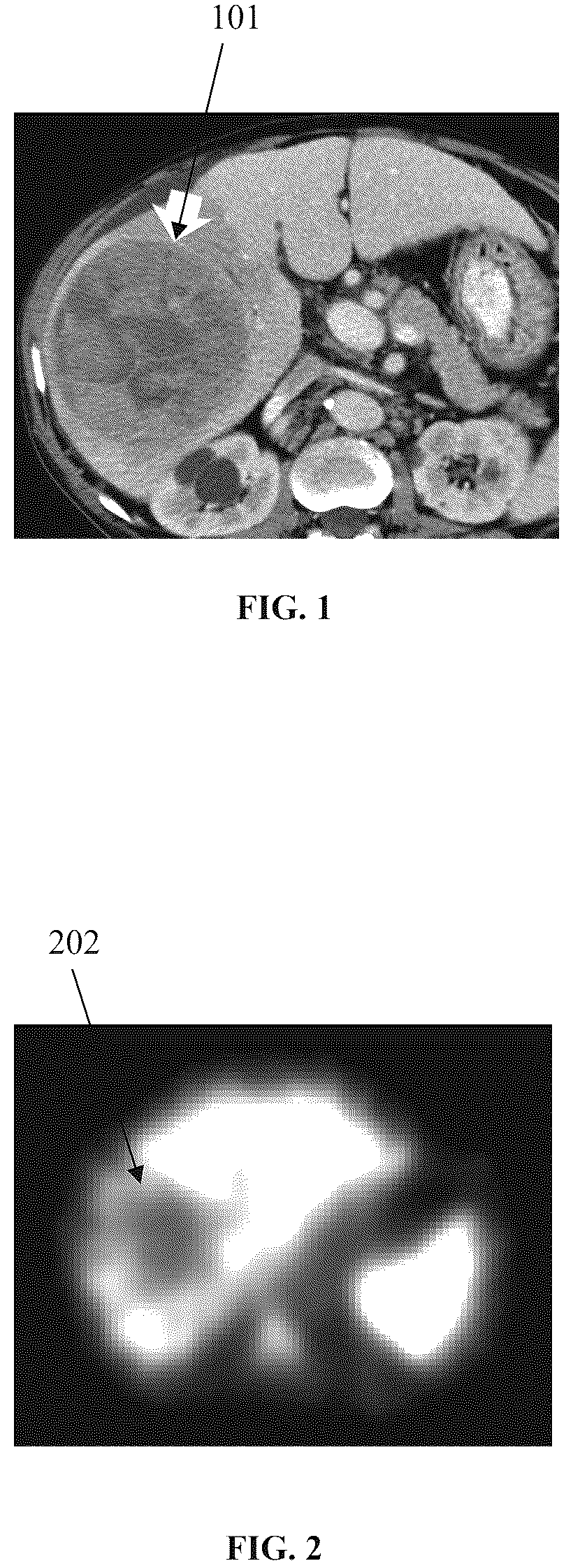 Patent US12620468 — Personalized liver cancer treatment — Figure 1